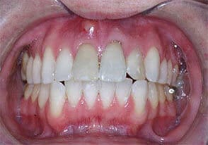 ballston smile gallery case-13-before