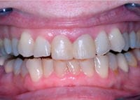 Veneers before