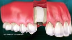 Bone Graft With Immediate Implant Placement 005