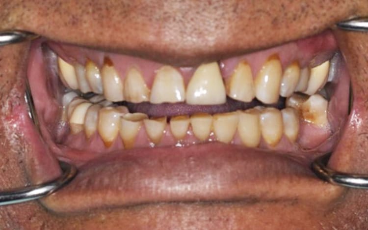 28. Patient GD (26 teeth + 2 implants - one implant is a front tooth!)_ 13 upper teeth with one front tooth porcelain implant crown and 13 lower porcelain crowns Before