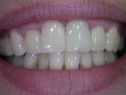 Veneers after