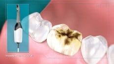 Single Crown image 002