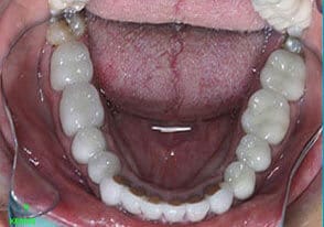 ballston smile gallery case-4-after