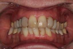 Veneers before