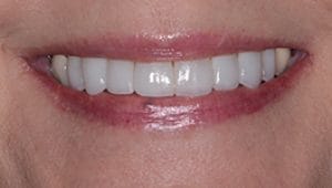 Porcelain Veneers After