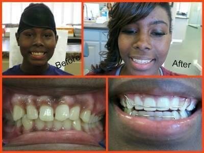 Before and after