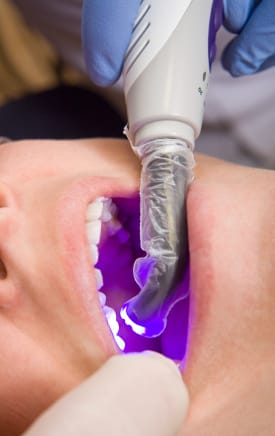 Composite Filling