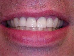 Veneers after