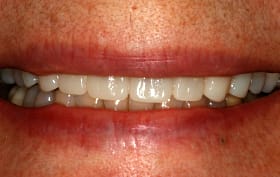 Smile Gallery - after