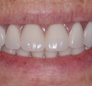 Dental Implants After
