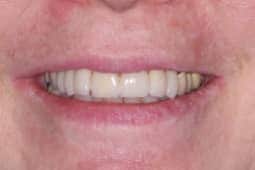Veneers after