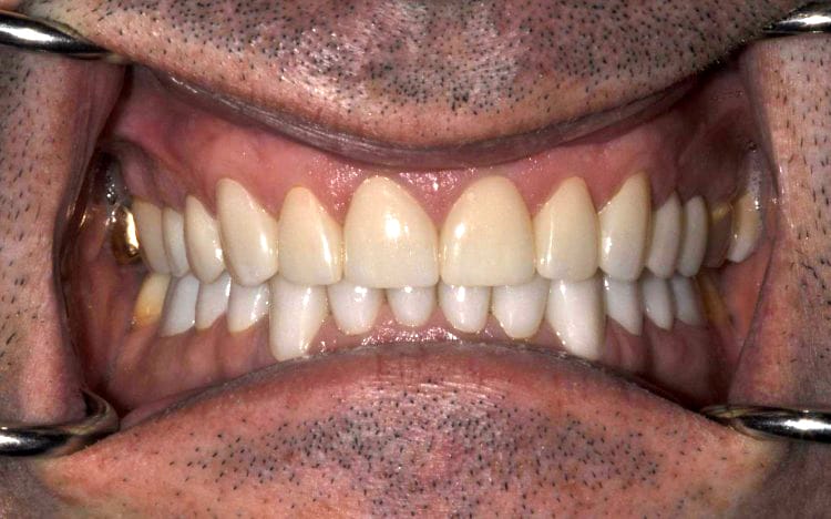 25. Patient PT (22 teeth)_ Combination of orthodontic work prior to 12 porcelain crowns on upper teeth and 10 porcelain crowns on lower teeth After