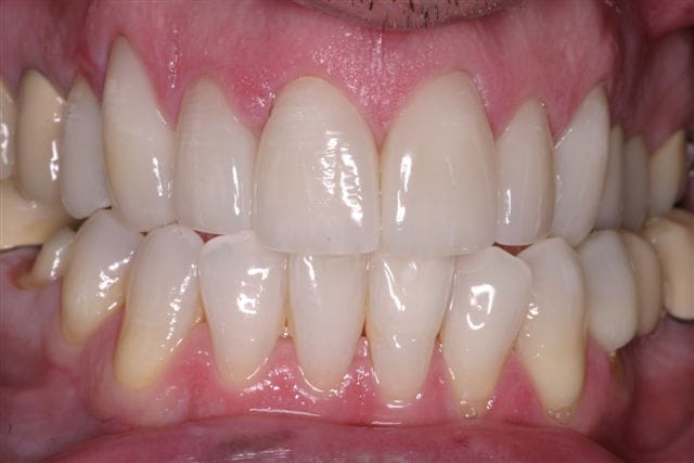 Rasner Smile gallery after 23