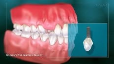 Single Implant (Anterior - Healing Cap) 001