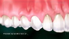 Single Implant (Anterior - Immediate Load) 005