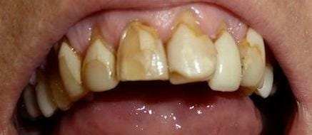 Grapevine Before Smile Transformation