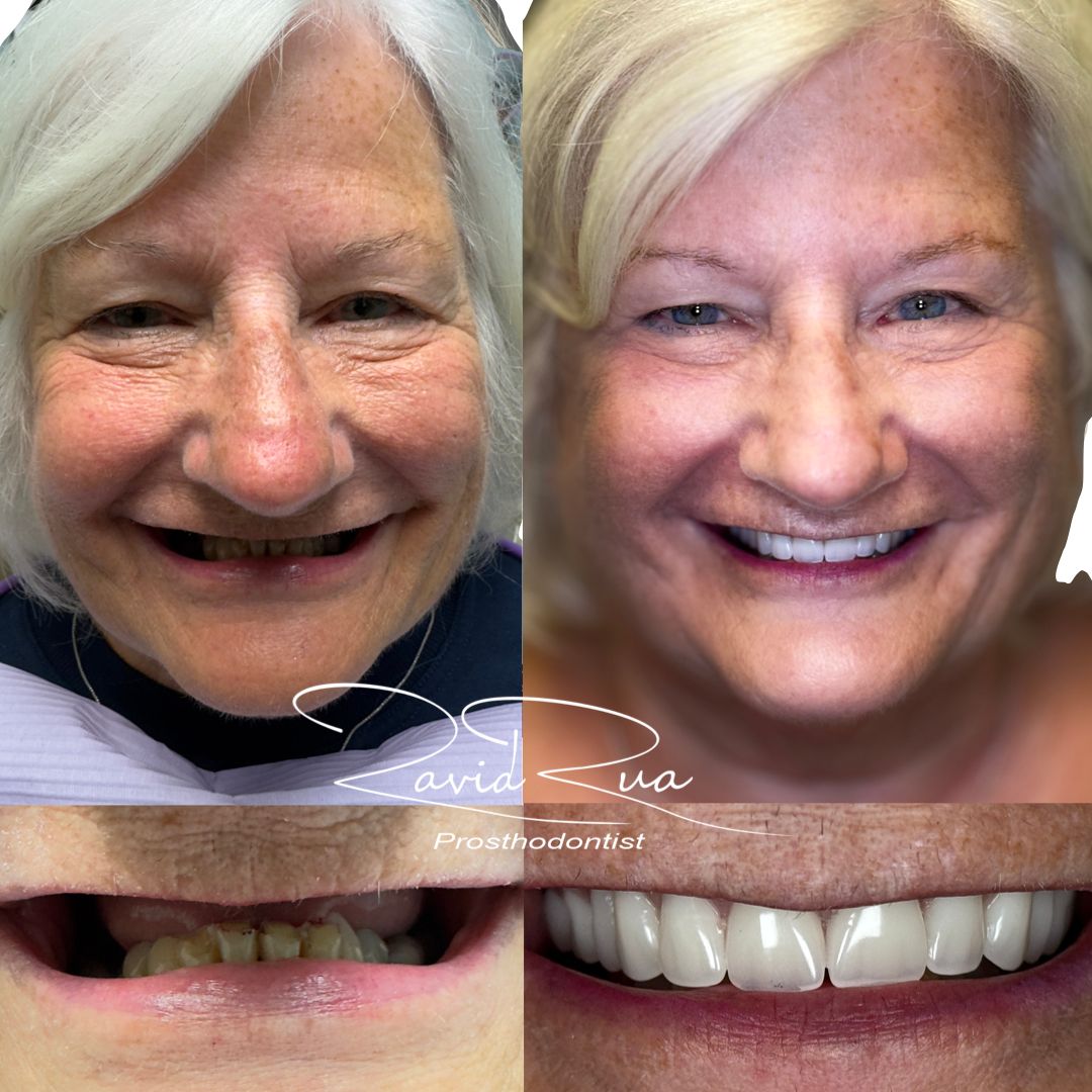 TC Cape Coral Case 6 Top denture