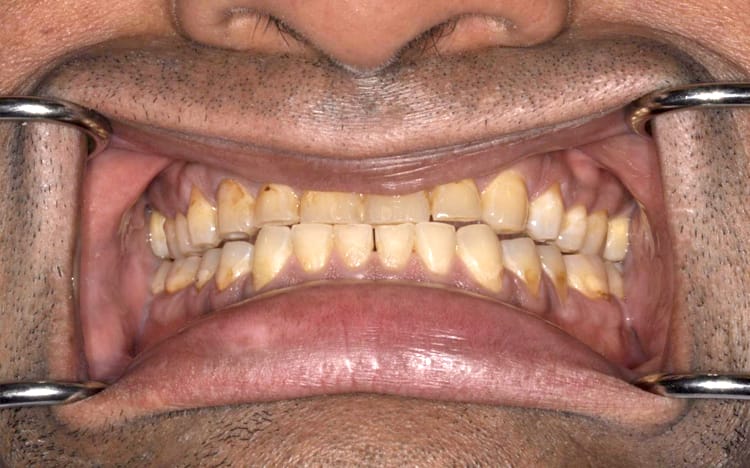 26 (1). Patient VB (all 28 teeth) _ 14 upper porcelain crowns and 14 lower porcelain crowns Before