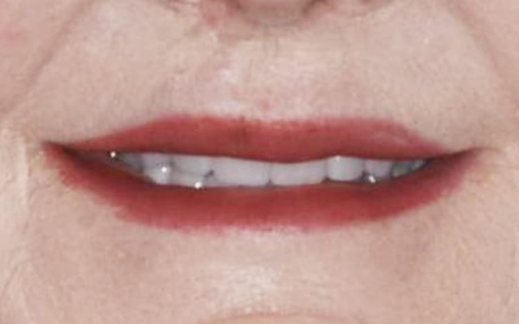 24. Patient ED (18 teeth + 3 implants)_ 8 upper porcelain crowns with 4 porcelain crowns on lower back teeth with and implant supported bridge for lower front 6 teeth After