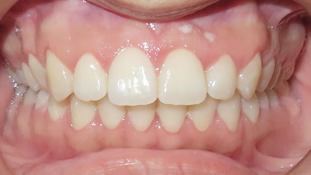 BF Ortho Smile Gallery After
