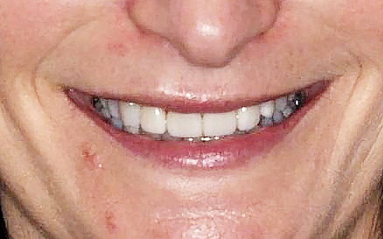 6. Patient SF (4 teeth)_ 4 porcelain veneers on front teeth After