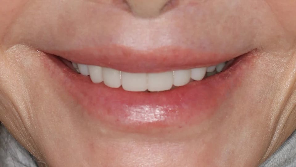 Anastasia Smile 09 after image