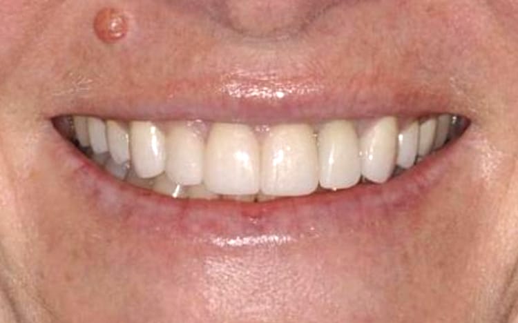 14. Patient RL (9 teeth, 1 implant)_ Porcelain crowns and an implant crown on upper 10 teeth After