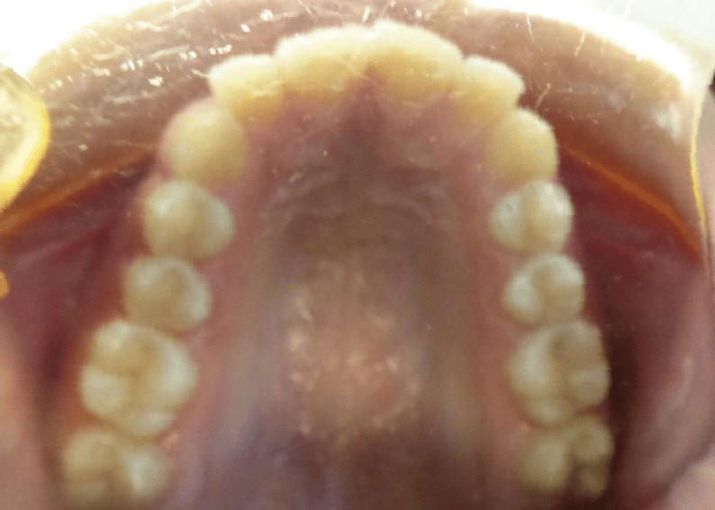 Top Jaw for Virtual Orthodontic Consultation