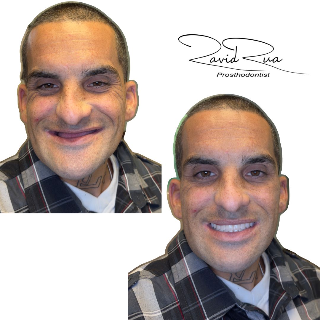 TC Cape Coral Case 15 Top and bottom complete dentures