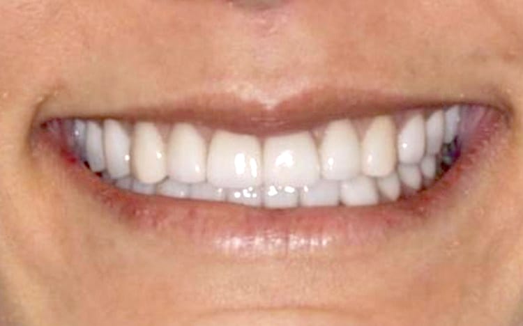 27 (1). Patient MR (all 28 teeth)_ 14 upper porcelain crowns and 14 lower porcelain crowns After