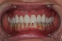 Full Arch Porcelain Restoration after