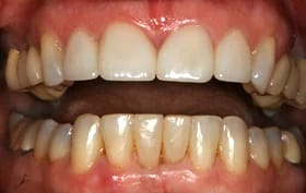 Smile Gallery - after