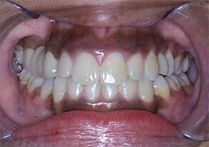 ballston smile gallery case-2-after