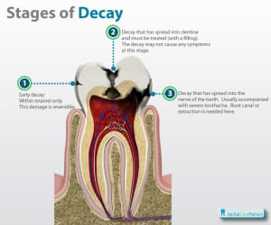 Stages of tooth declay