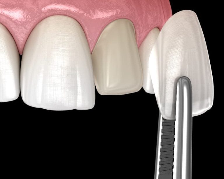 Worthwhile Changes- Removing Enamel for Veneers Worthwhile Changes- Removing Enamel for Veneers