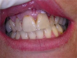 Veneers before