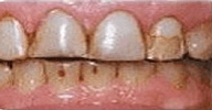 Before and After