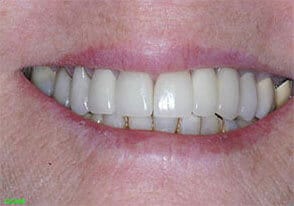 ballston smile gallery case-3-after