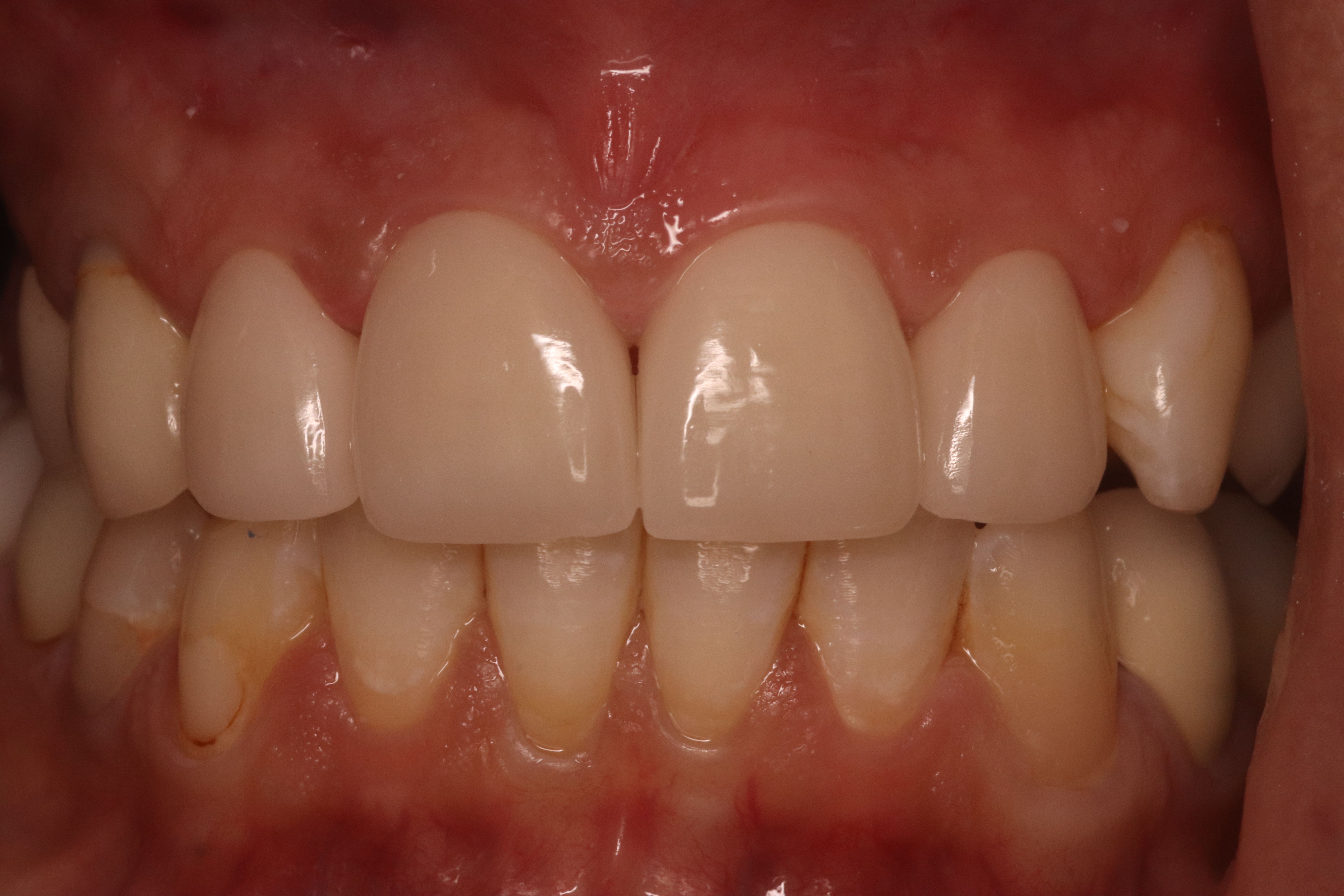 Rasner Smile gallery after 8