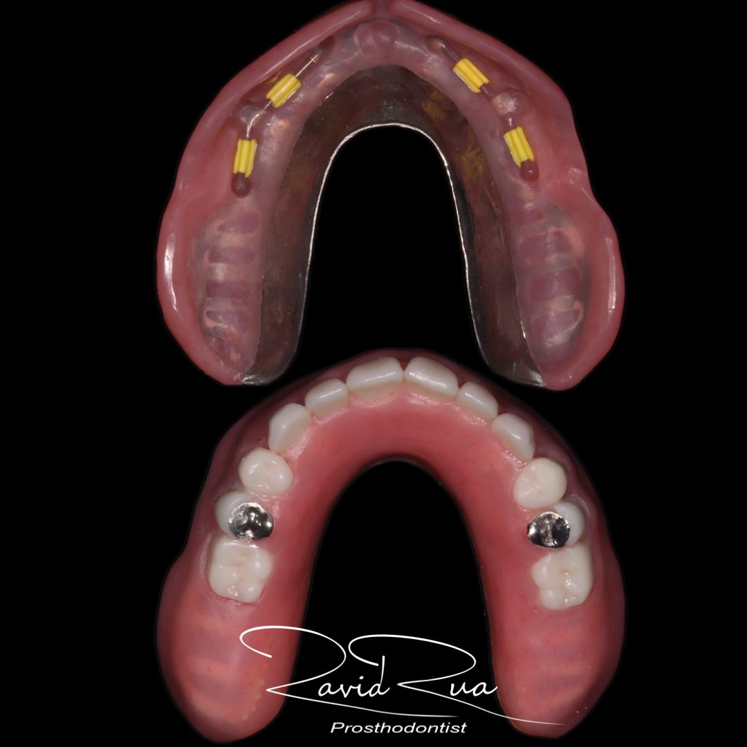 TC Cape Coral Case 16.2 Top and bottom implants overdentures