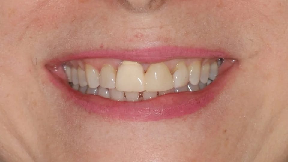 Anastasia Smile 12 before image