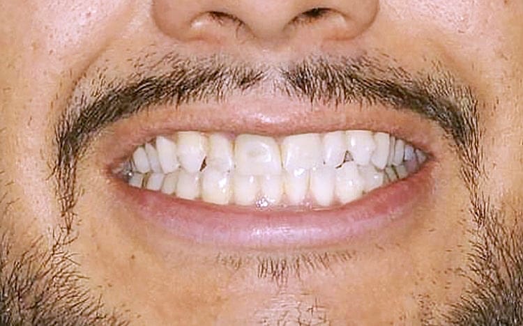 8. Patient J.D_ 2 porcelain crowns for smaller peg lateral teeth, implant front tooth with custom tissue shaping and porcelain implant crown, and front tooth porcelain veneer Before(2).jpg