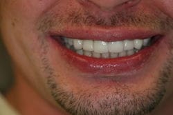 Veneers after