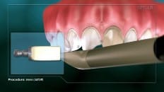 Veneers image 004