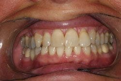 Veneers before