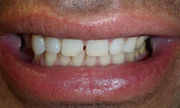 Grapevine Before Cosmetic Dentistry 1