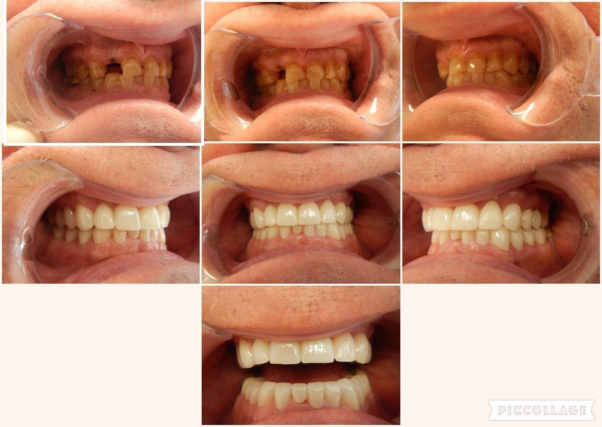 Smile Gallery - before and after 4