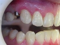 Implants before