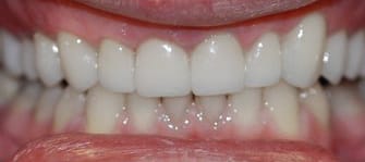 After Crowns