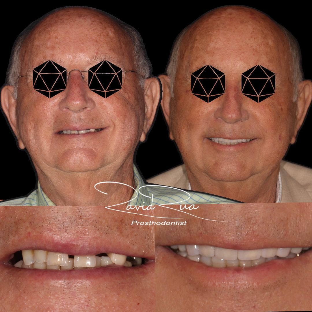 TC Cape Coral Case 19 Full mouth rehab, Implants , crowns and partial